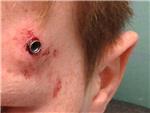 Un nio de once aos recibe un disparo de perdign en la cabeza mientras jugaba al ftbol
