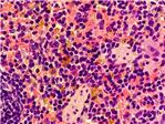 El CNIO descubre la relacin entre una anemia poco frecuente y el cncer