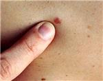 El melanoma es uno de los tumores que ms retos plantea a los investigadores por su agresividad