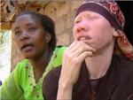 Entre parntesis | El proyecto 'Albinos en Tanzania' salva vidas