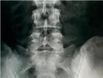 Lumbalgia, citica, hernia discal: la solucin quiroprctica