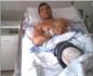 La sanidad valenciana retira una prtesis de 152 euros a un joven que no poda pagarla