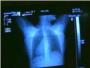 El cncer de pulmn, un gran desconocido y uno de los ms agresivos y mortales