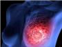 Un 5% de los casos de cncer de mama se diagnostican ya en fase metaststica