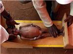 52 millones de nios en el mundo sufren desnutricin aguda