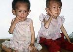 La desnutricin infantil azota Corea del Norte