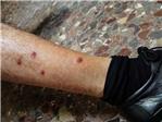 Proliferan las personas afectadas por picaduras de mosquitos en el paseo fluvial de Alzira