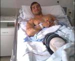 La sanidad valenciana retira una prótesis de 152 euros a un joven que no podía pagarla