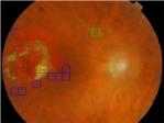 Desarrollan un nuevo sistema para la detección temprana de daños en la retina