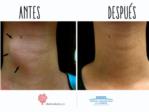 El Hospital de La Ribera incorpora la técnica más avanzada para eliminar el aumento de tiroides sin cirugía abierta