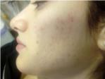 Elimina las manchas y cicatrices del acné en Vía Natura, Cullera