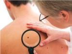 Un estudio de Incliva identifica biomarcadores que predicen la supervivencia en pacientes con el cncer de piel ms agresivo