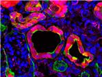Un gen provoca la aparicin de la fibrosis renal