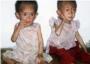 La desnutrición infantil azota Corea del Norte