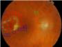 Desarrollan un nuevo sistema para la detección temprana de daños en la retina