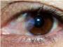 Descubierto el mecanismo molecular que origina las molestias de la enfermedad del ojo seco